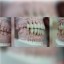 التجميل باستخدام التيجان و الجسور