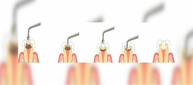 معالجة نخر الأسنان بالطريقة الكيموميكانيكية