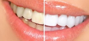 لماذا يكون تبييض الأسنان مؤلماً